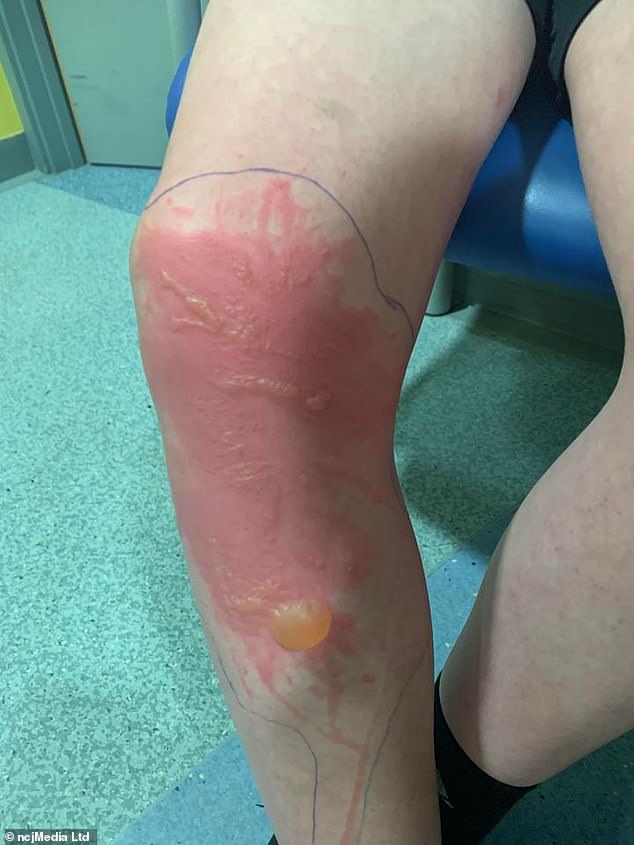 Michael's blistered legs were treated with cold water, gas and air as well as a dressing including honey