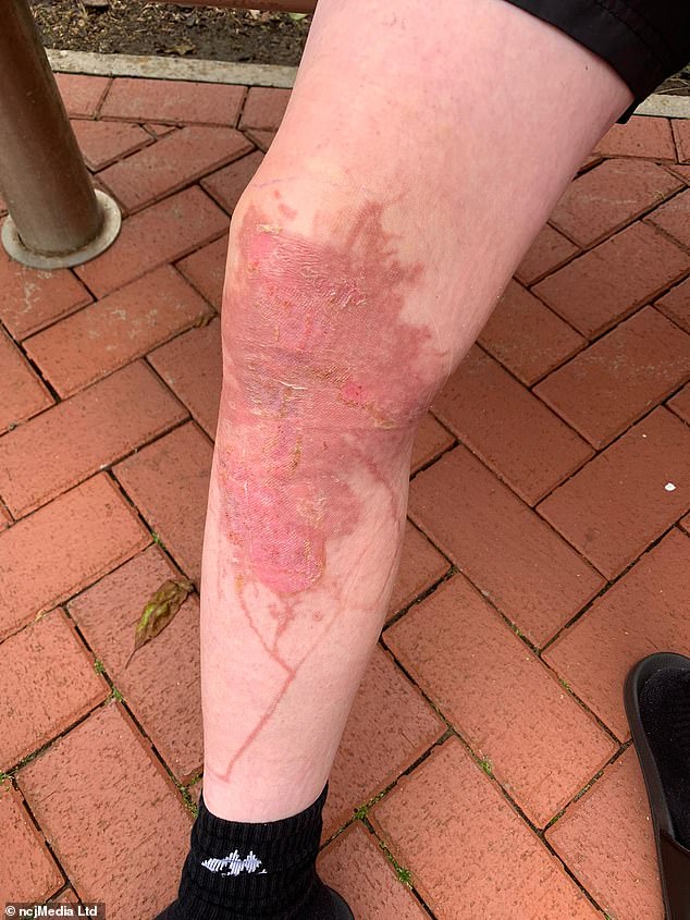 Michael Taylor spent four nights in hospital and missed two weeks of school after a nasty brush with a giant hogweed