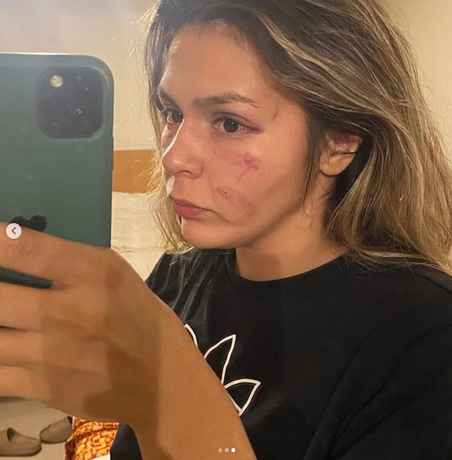 Brianda Tamara, who fought against transgender woman's boxer Imane Khelif in December 2022, revealed these pictures online detailing her injuries following the match