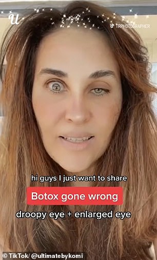 One TikTok account @ultimatebykomi which shares videos of 'beauty gone wrong' shared a video its 1.1 million followers of a woman who was left with one drooping eye and an enlarged eye after getting Botox