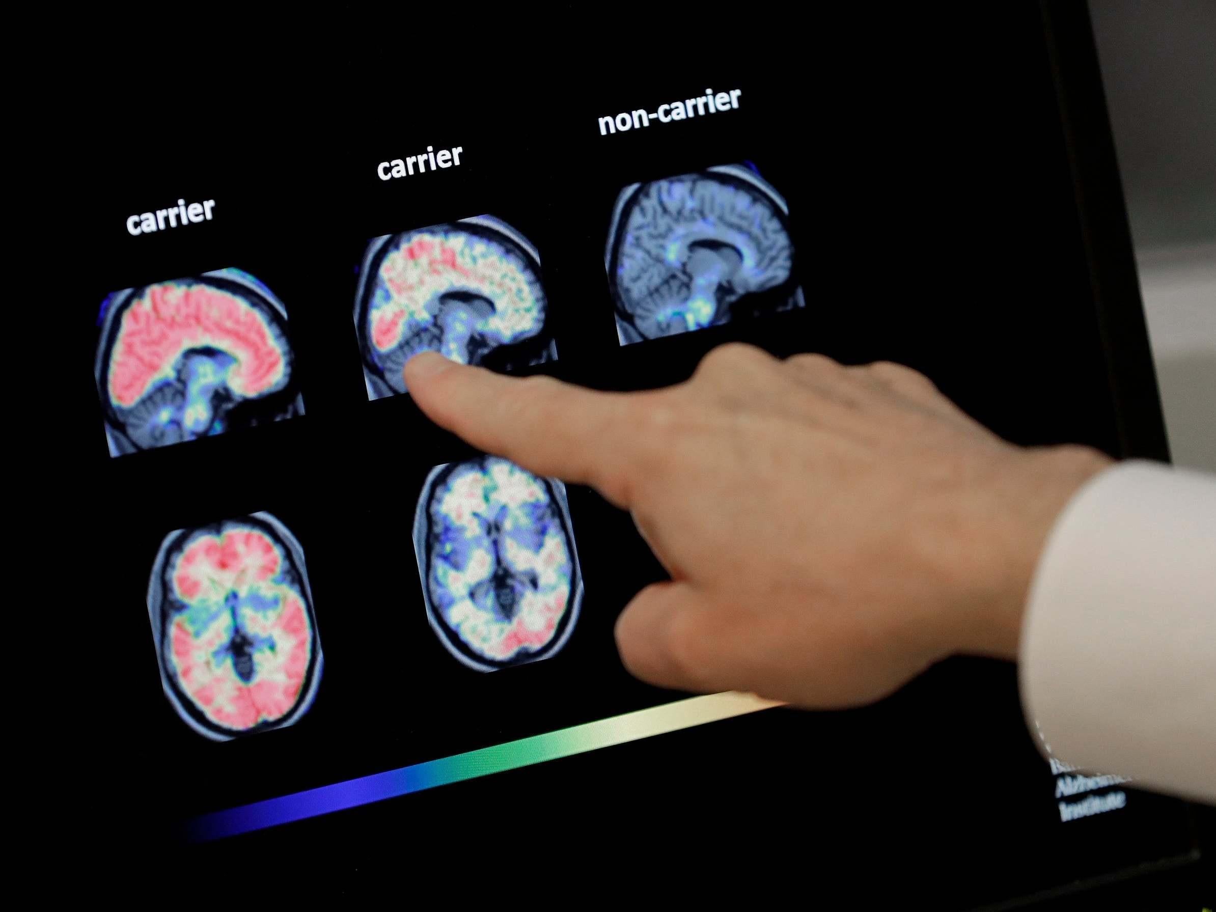 The highest risk of dementia was found in people whose immune system aged faster than usual – not in people whose brains aged more rapidly