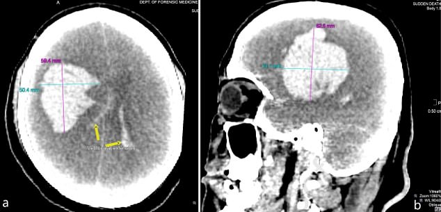 Post-mortem scans of the man's head revealed he had suffered a stroke, resulting in a 300g mass of clotted blood, pink and blue lines. Yellow arrows indicate blood vessels in the brain that have been extended as a result of the haemorrhage