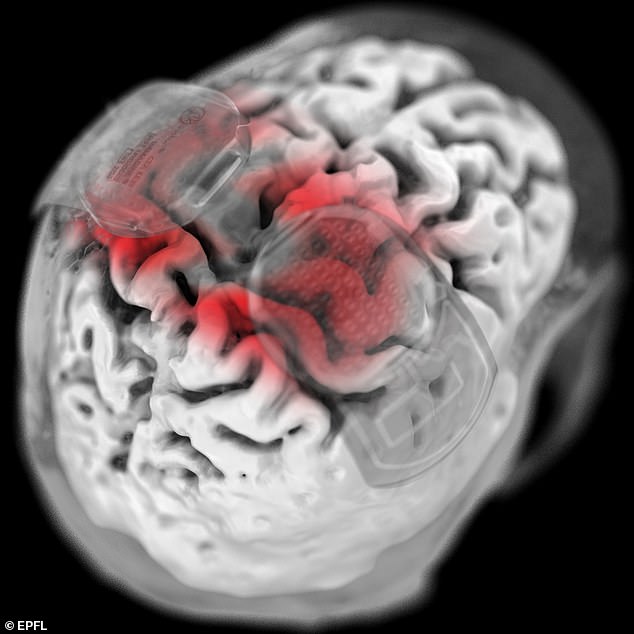 One implant is placed in the patient's brain (pictured), above the region responsible for leg movements, while the second is placed on the region of the spinal cord that controls leg movement