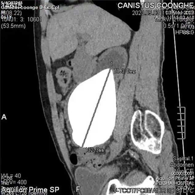 Doctors at Army Hospital, Colombo, Sri Lanka, said that despite it being lodged in his right kidney, his organs surprisingly worked fine