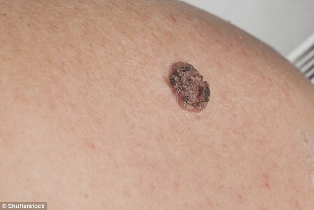 Melanoma kills about 2,300 people in the UK every year, while squamous cell carcinoma leads to about 1,000 deaths