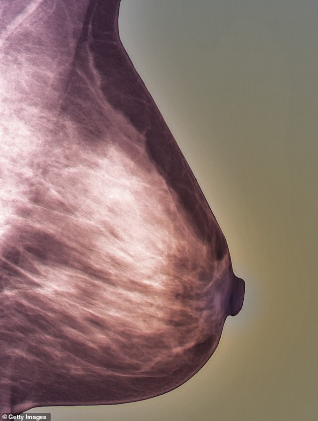 Inflammatory breast cancer, which accounts for up to 5 per cent of breast cancers, is often missed by mammography. Pictured: A normal mammogram of a 27-year-old patient