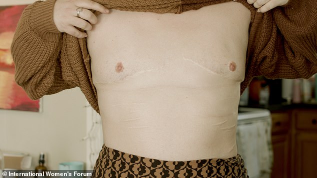 A young woman shows the scars from the breast-removal operation she underwent as a teenager and now deeply regrets