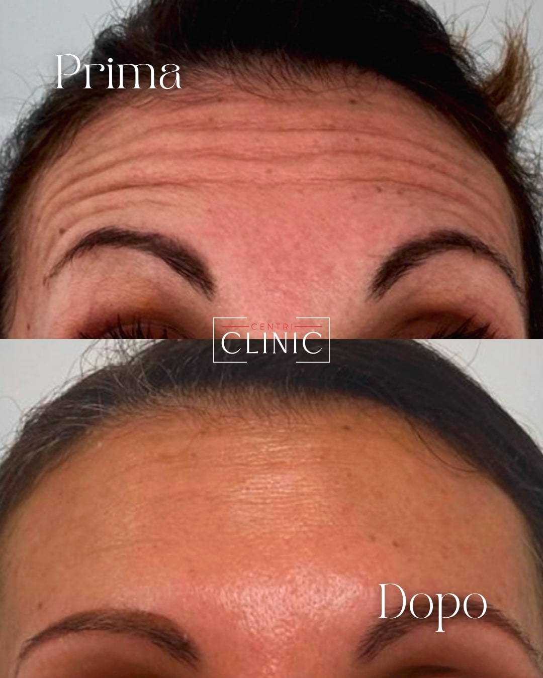 Botox per il Viso. Addio Rughe nei Centri Clinic