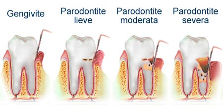 paradontite e gengivite