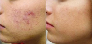 peeling viso chimico