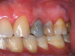 dente nero