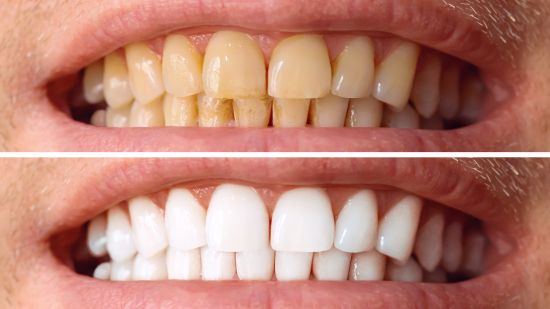 sbiancamento denti1 sbiancamento denti1