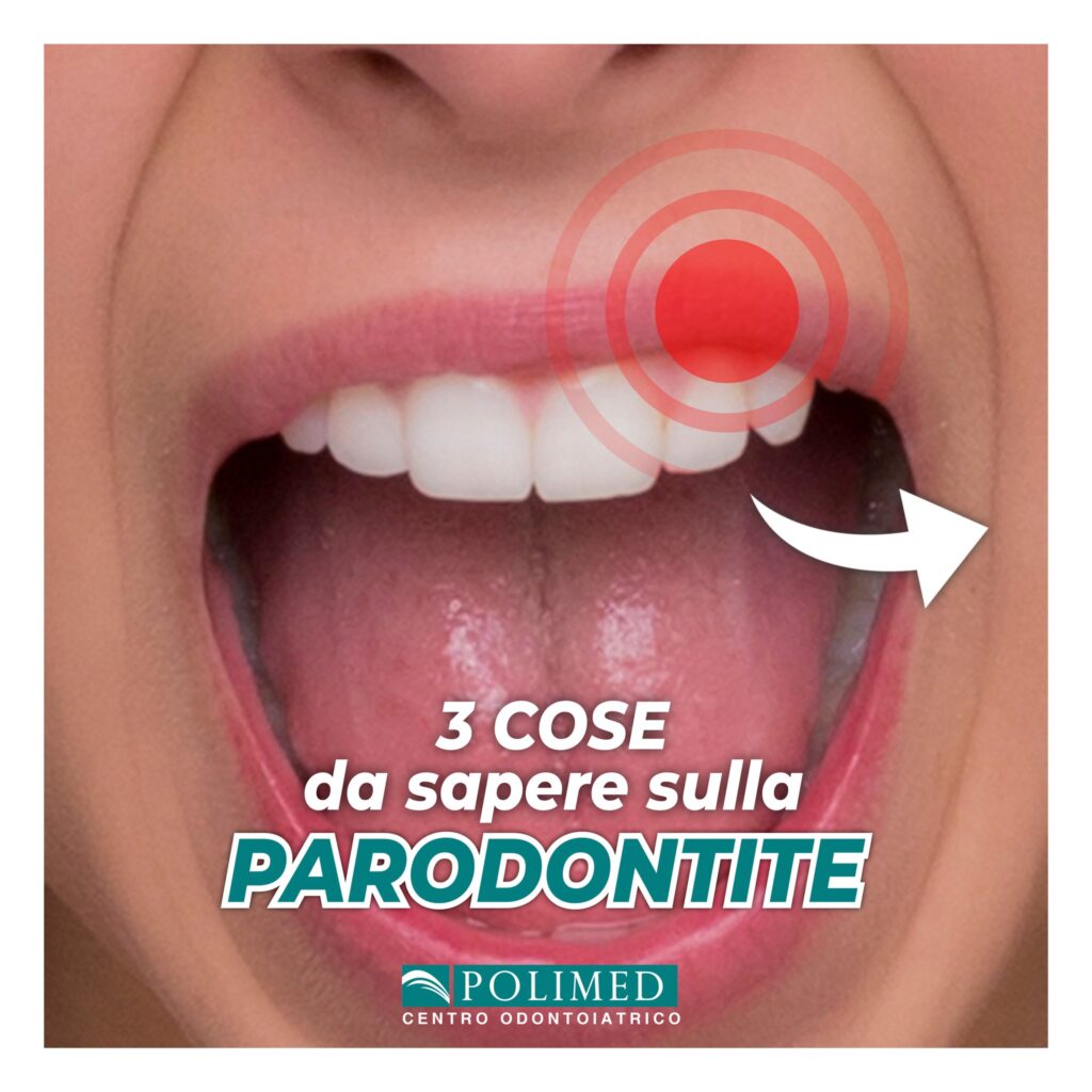 paradontite