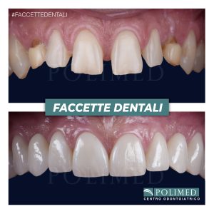 Vista intraorale prima e dopo il trattamento con faccette dentali in ceramica feldspatica al Centro Polimed Afragola