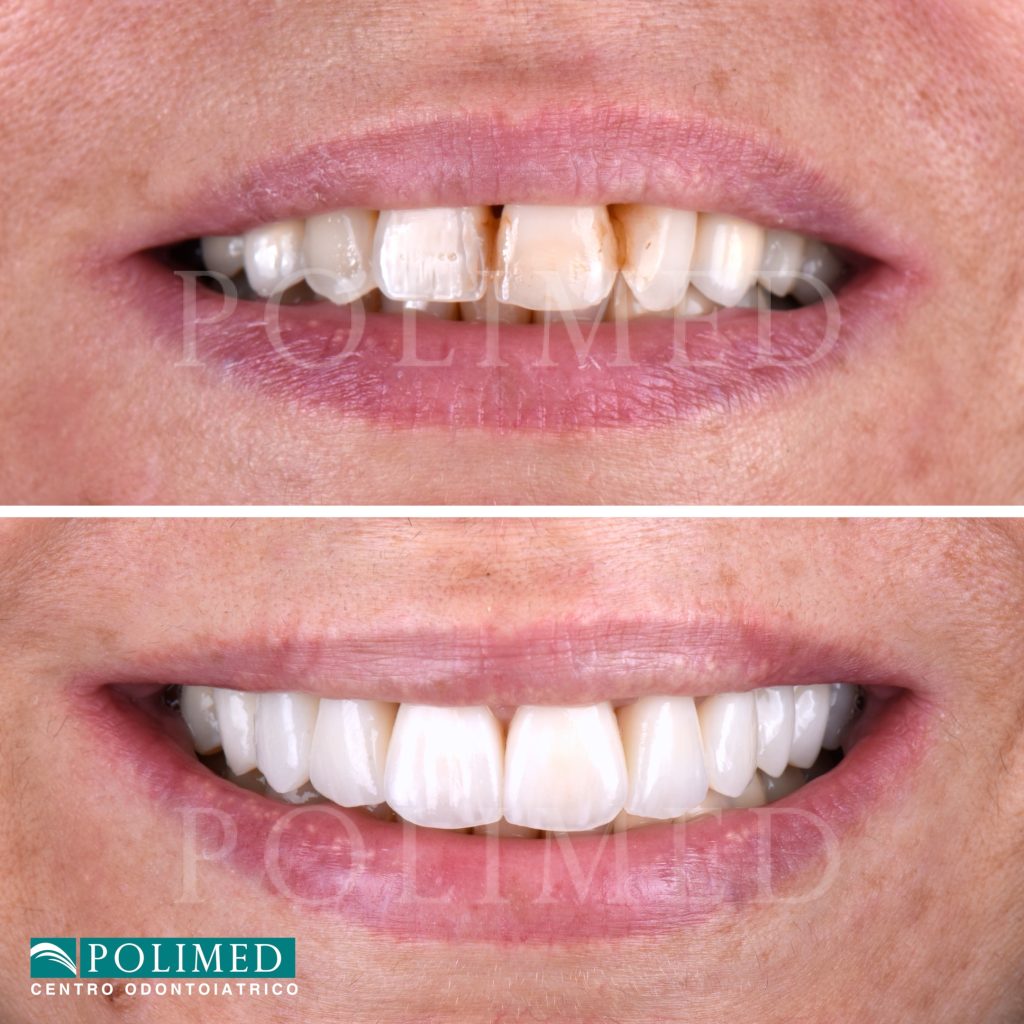 Faccette dentali prima e dopo