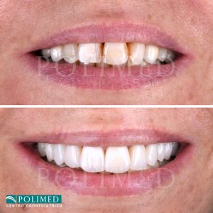 Risultato prima e dopo con faccette dentali in ceramica feldspatica al Centro Polimed Afragola