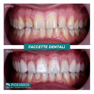 Trattamento estetico con faccette dentali in ceramica feldspatica su arcata superiore al Centro Polimed Afragola