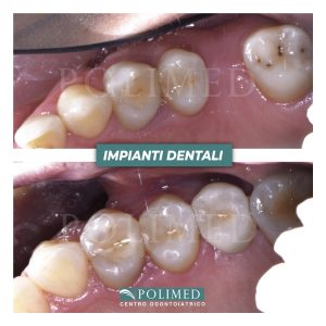 Fotografia clinica di un impianto dentale singolo posizionato su arcata posteriore presso Centro Polimed Afragola