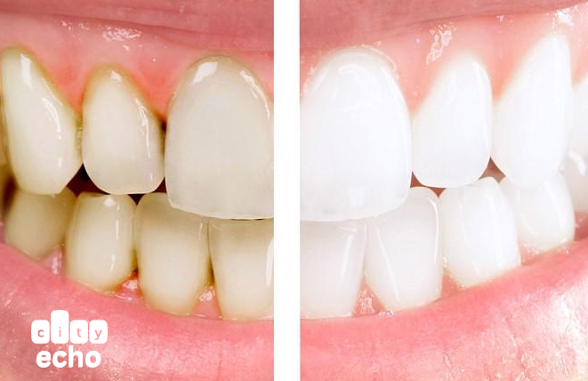 local dental implants