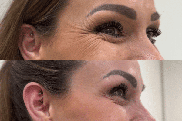 botox før og efter resultat hos Clinic Invitus i Vejle