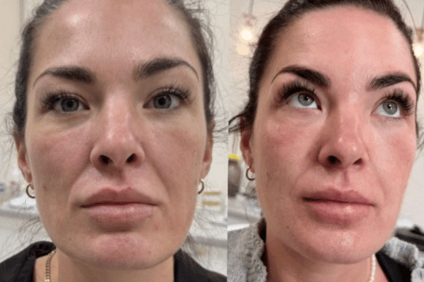 PRF behandling hos Clinic Invitus i Vejle