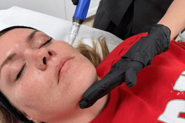 microneedling behandling hos Clinic Invitus i Vejle
