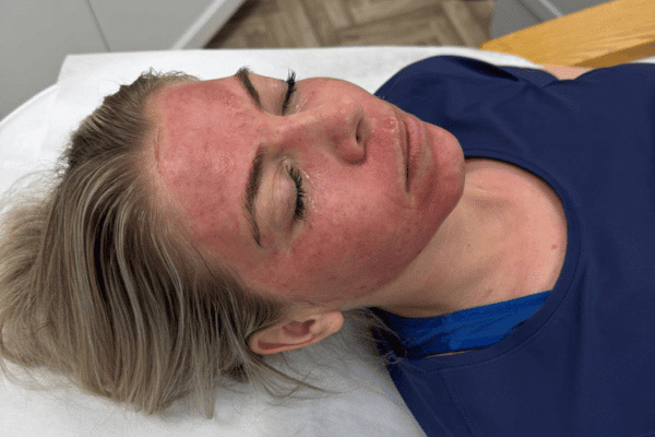 Microneedling Vejle