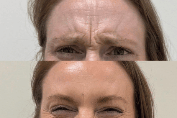 før og efter botox behandling med naturligt resultat