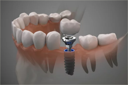 clonicasorriso implantologia dentale