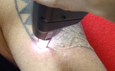 Een tattoo verwijderen