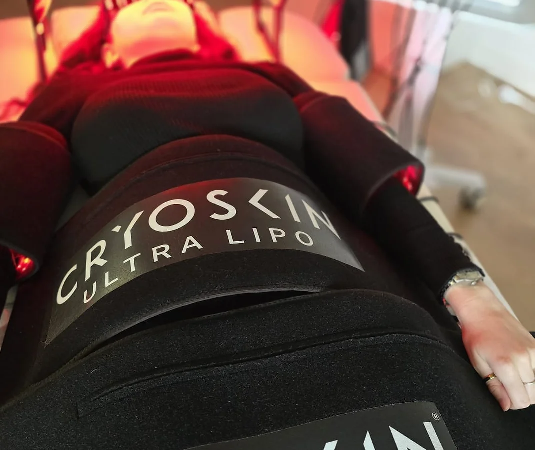 woman in a cryoskin ultra lipo device