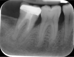 Before-Dental-Laser-Bone-Gone