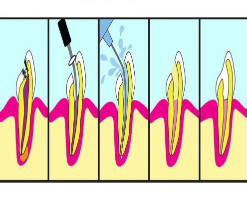 Root-Canal-Treatment