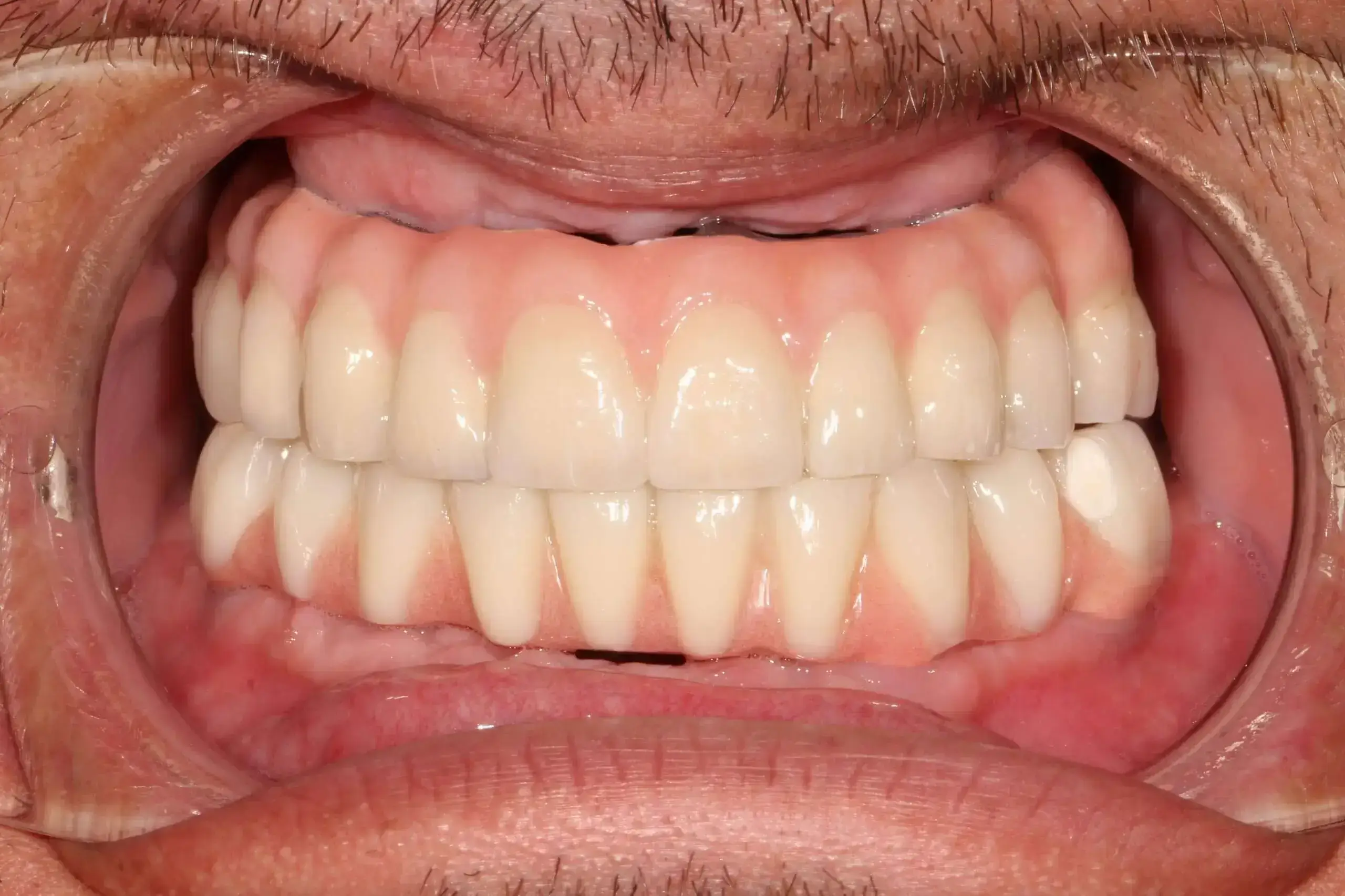 Hel munnen med tandimplantat. Båda käkarna tandimplantat. Helbro på titanskruvar. Nya tänder. fasta tänder sitter fast.