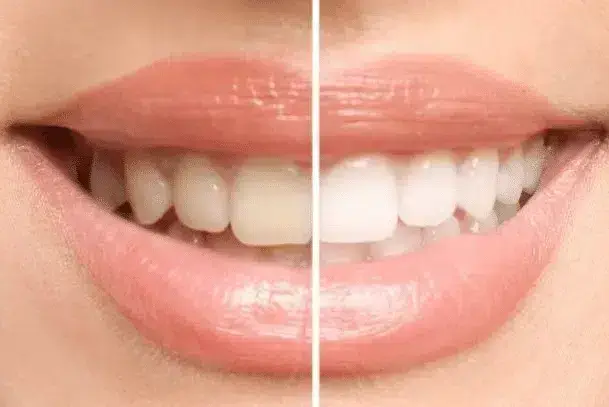 Tandläkare pris & kostnad, Tandvård pris & kostnad, Tandblekning. Missfärgade tänder. Mörka tänder. Tandfärg. Vita tänder. Vitare tänder. vit tandfärg. Tandblekningsmedel.