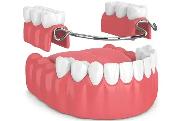 Tandläkare pris & kostnad, Tandvård pris & kostnad, Tänder man kan ta av. Delprotes. Plasttänder. Avtagbar tandersättning. Avtagbar protetik. Klammer protes. Temporär protes.