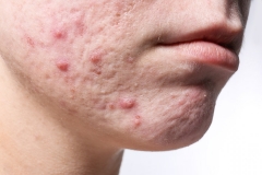 Young woman with acne on her face, closeup