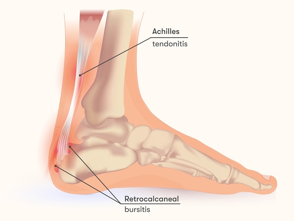 Slimposebetennelse bakpå hælen (retrocalcaneal bursitt)