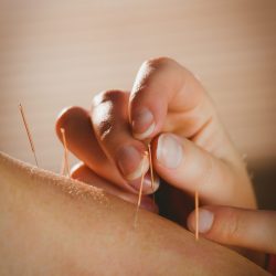 Young,Woman,Getting,Acupuncture,Treatment,In,Therapy,Room