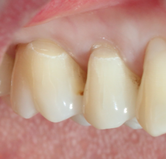 Abrasion Lesions – Olympia Dental Practice
