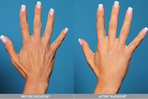 FILLERS FOR BACK OF HANDS