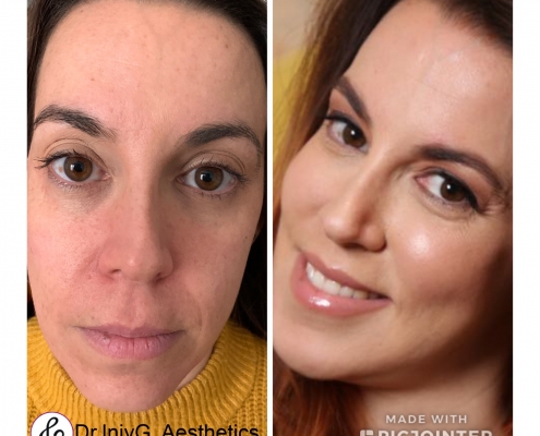 Complete fluid face lift and jawline definition