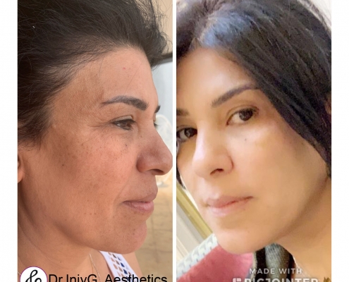 Fluid face lift and Mesotherapy