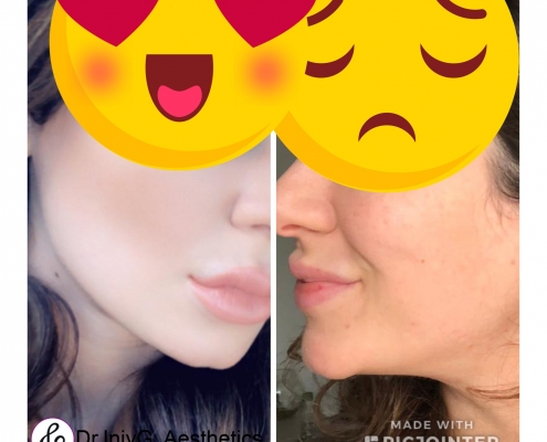 Jaw line definition and chin augmentation