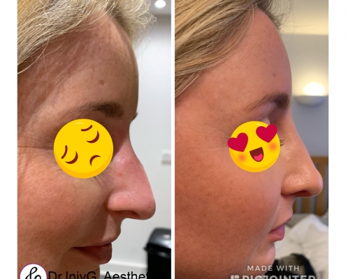 Non surgical rhinoplasty, fluid nose