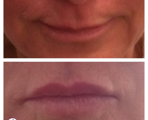 Subtle lip and chin rejuvenation