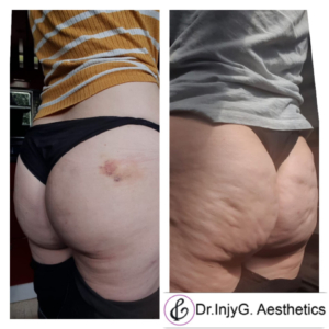 Lanluma Buttocks Augmentation