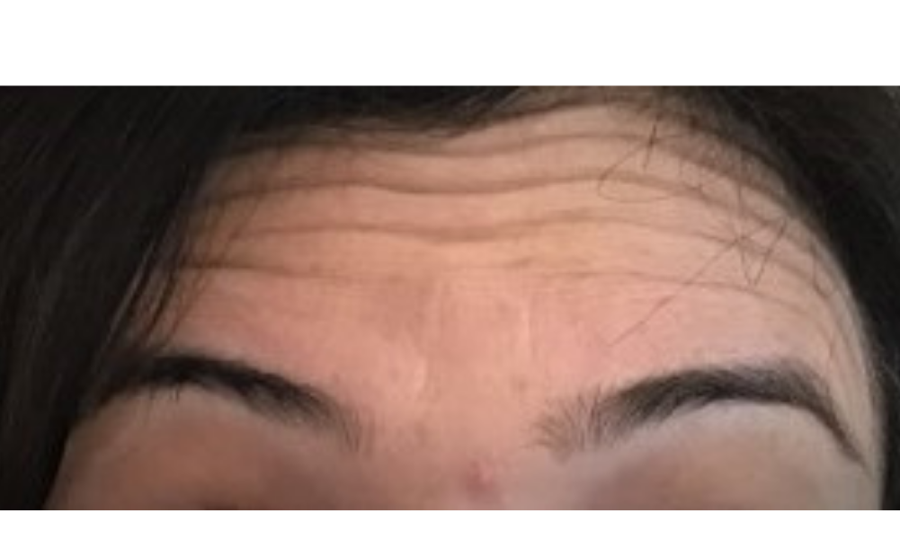 Wrinkle Relaxing Injections