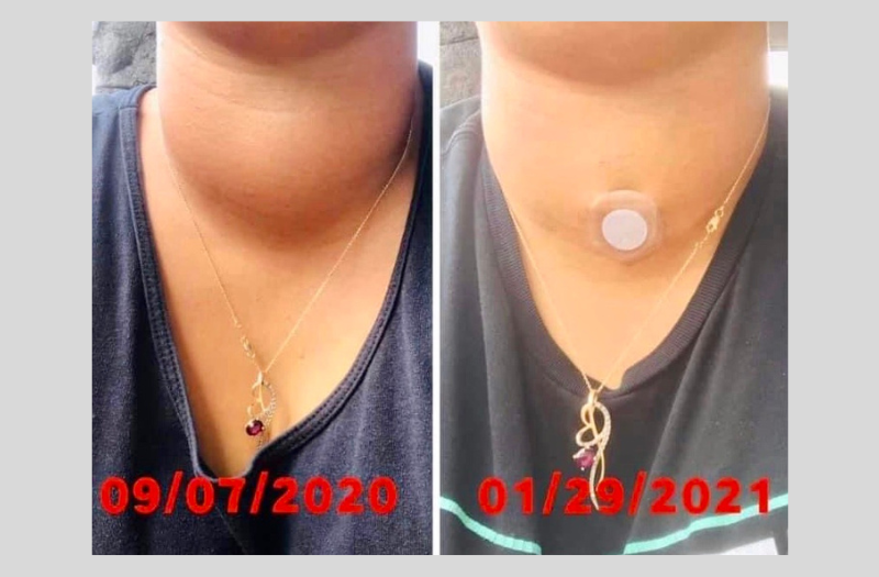 Before After Phototherapy