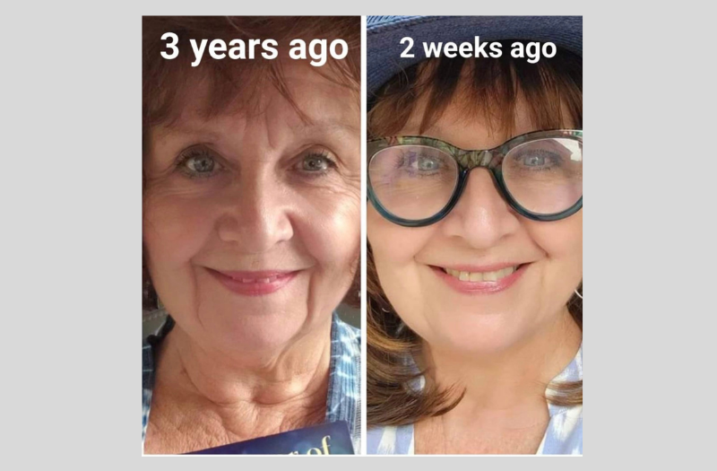 Before After Phototherapy